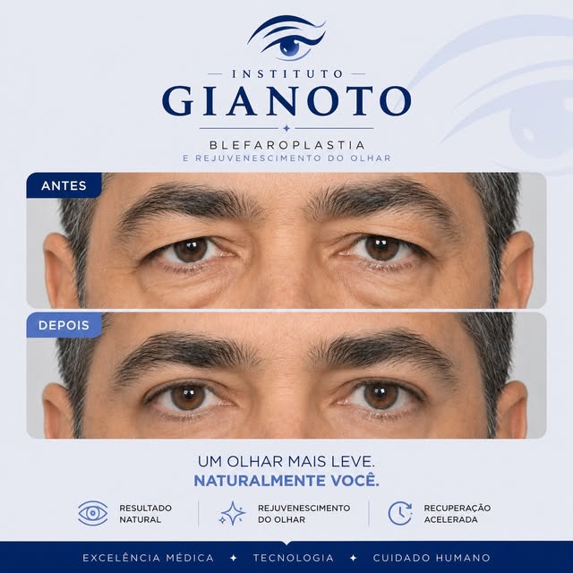 Antes e depois de blefaroplastia, redução do excesso de pele nas pálpebras superiores